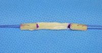 Patellar tendon autograft for ACL reconstruction (image courtesy of orthoinfo.aaos.org)