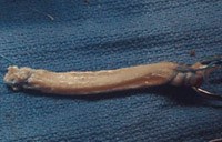 Quadriceps tendon autograft for ACL reconstruction (image courtesy of orthoinfo.aaos.org)