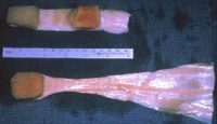 Patellar tendon (top) and Achilles tendon (bottom) allografts for ACL reconstruction (image courtesy of orthoinfo.aaos.org)