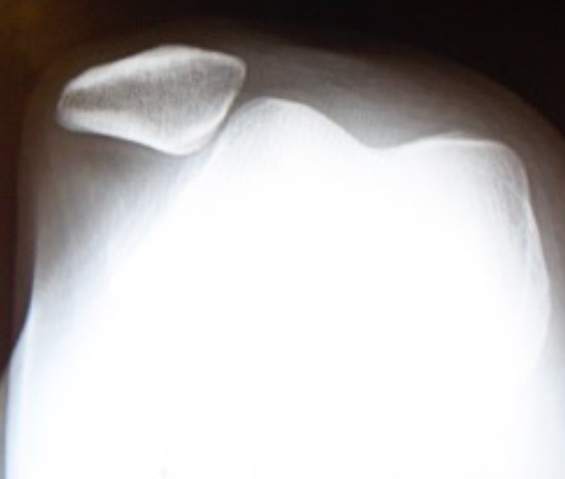 patella instabilty