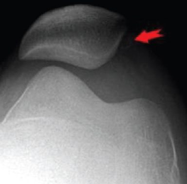 Lateral Patellar Tilt