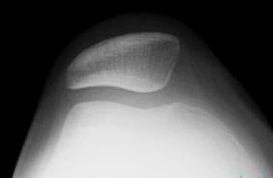 patellar instability