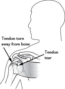 Rotator Cuff Tendon Tear